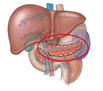 급성 췌장염